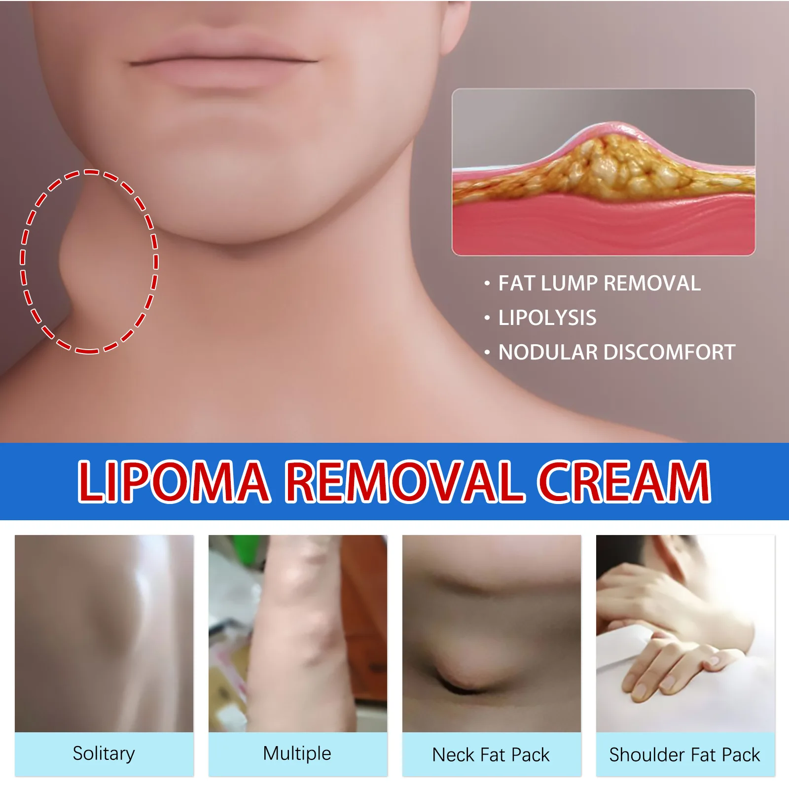 Lipoma Removal Cream Effectively Reduce Inflammation Treat Subcutaneous Lumps Fat Pack Shoulder Remove 20g