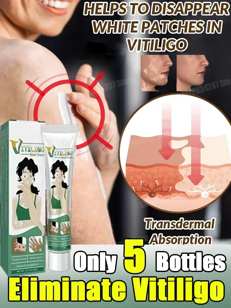 NewEffective vitiligo repair cream and white spot lightening product