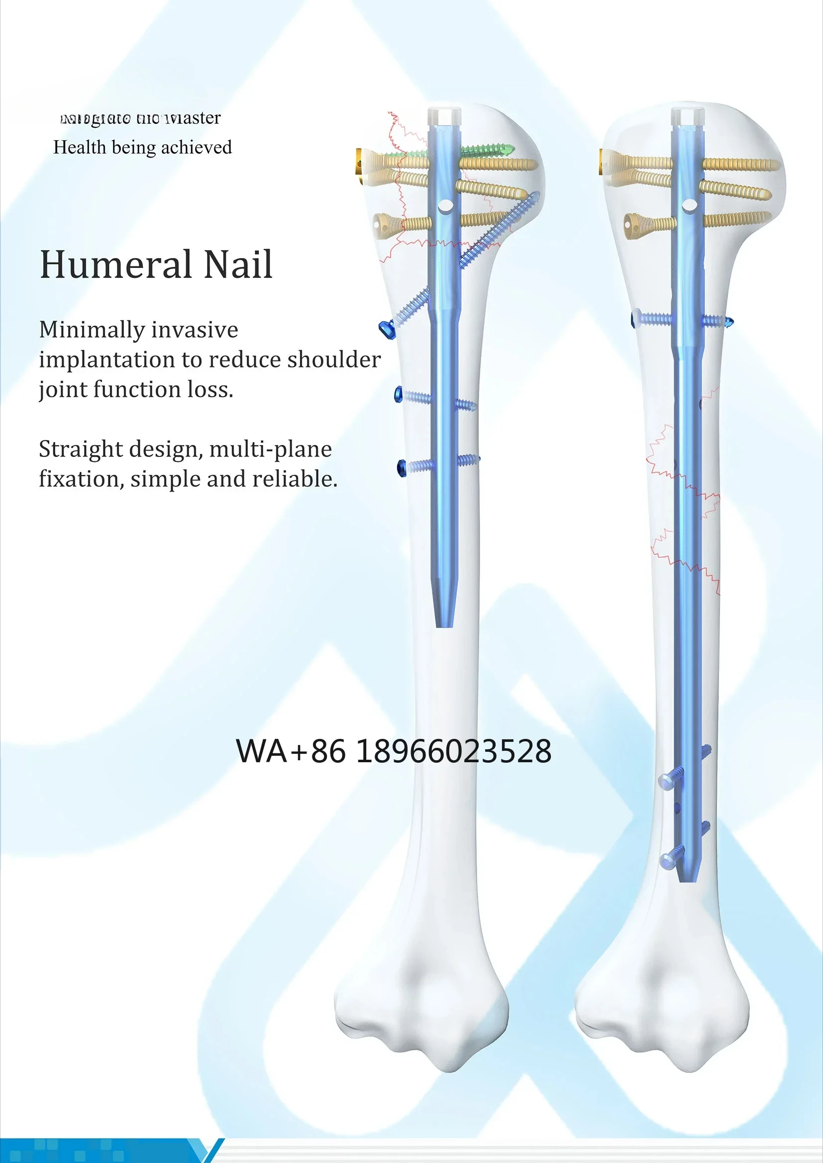 Implants Titanium With Locking Screw Multiloc Humeral Intramedullary Nail Interlocking