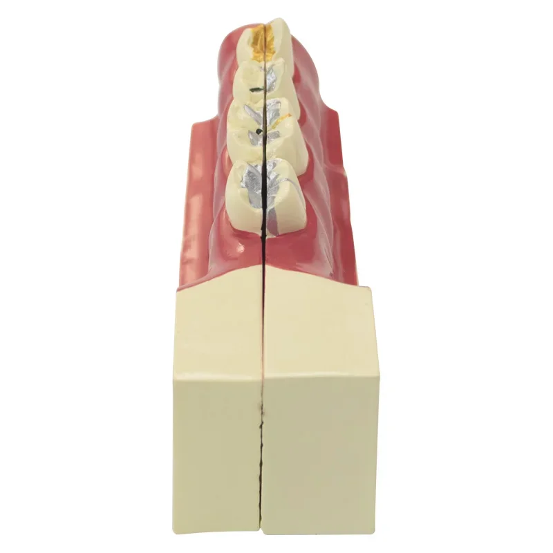 Tandheelkundig Onderwijsmodel Reparatie Pathologisch Getroffen Tandmodel Pulp Voor Tandartsonderwijs En Training Tandmagneettandheelkunde