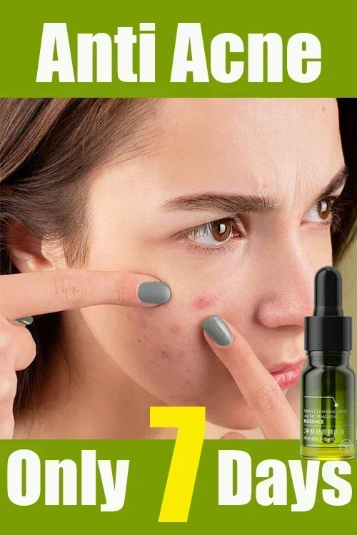 

Acne Treatment Face Cream Salicylic Acid Acne Scar Pimple Remover Whitening Oil Control Smoothing Facial Skin Care