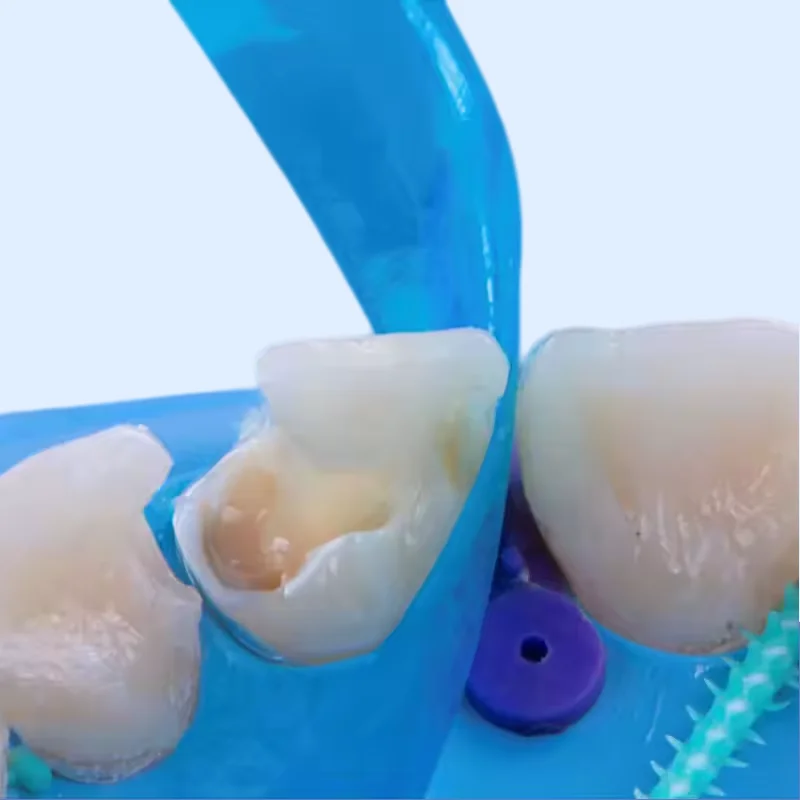Dental Contoured Anterior Matrix Strip Dentistry Material for Dental Resin Restoration view 2
