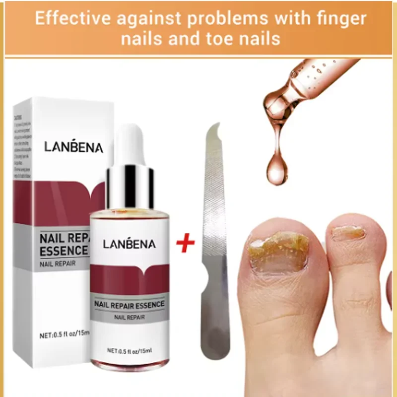 2024 LANBENA Fungus Care Remove Onychomycosis Toes Nourish Brighten Hands Feet Product Repair Suitable Women Nail Pepair Essence