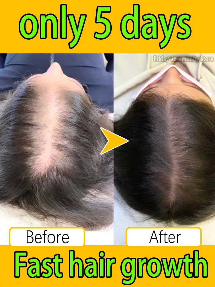 100% repair hair loss and hair follicle loss, solve hair loss and baldness