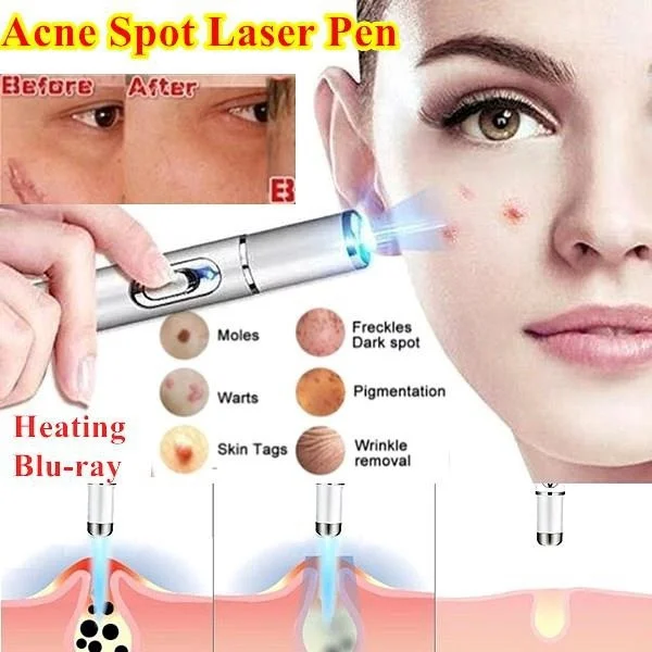 For Dropshipping Acne Laser Pen Portable Wrinkle Removal Machine Durable Soft Scar Remover Device Blue Light Therapy Pen Massage