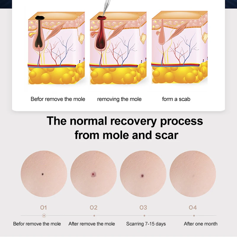 강력한 나이 사마귀 연소 장치, 피부 태그 화상 연필 장치, 유두종에서 두더지 제거기 제거
