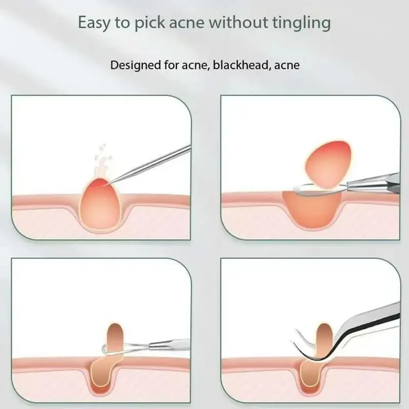 8ピースステンレススチールのにきび除去ツールセット、収納ボックス、にきびクリップピンセット、にきび針ツール、美顔器付き