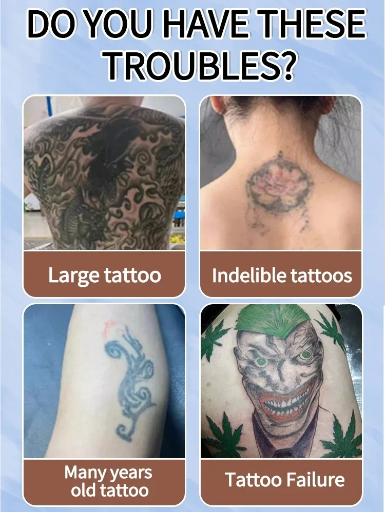 كريم إزالة الوشم، مناسب للوشم الكبير والصغير، فعال في إزالة الوشم الدائم