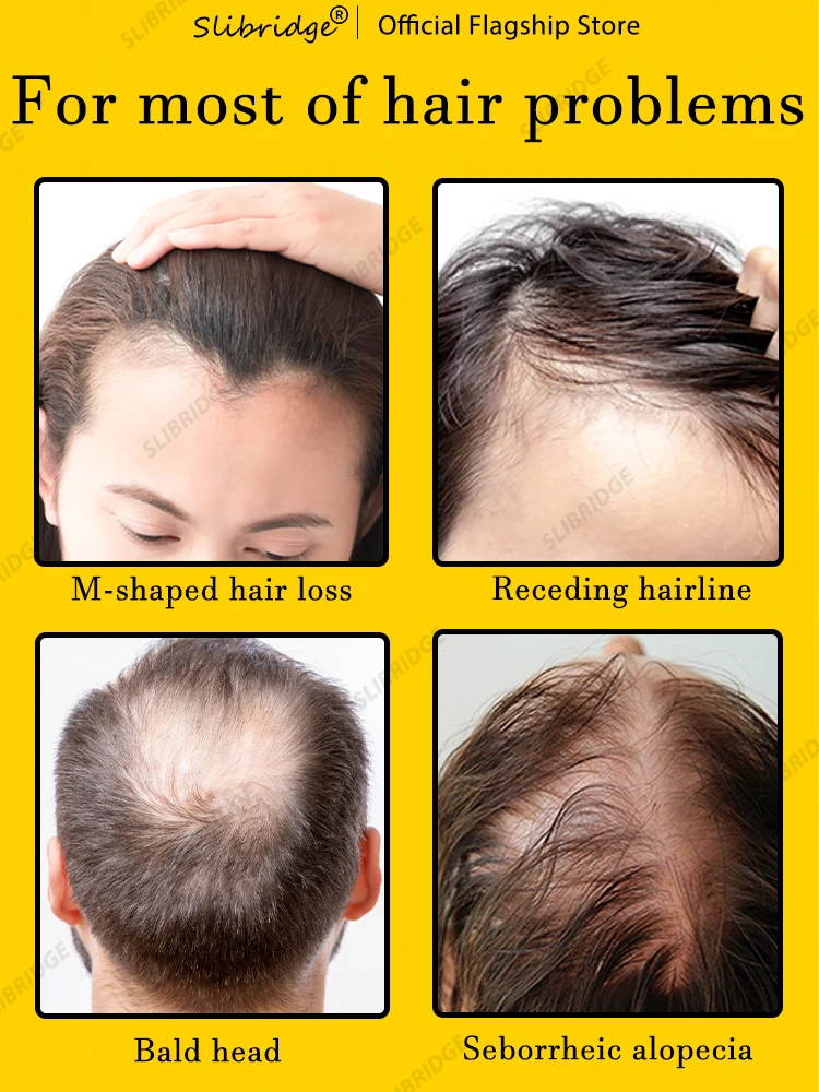 Solve baldness troubles