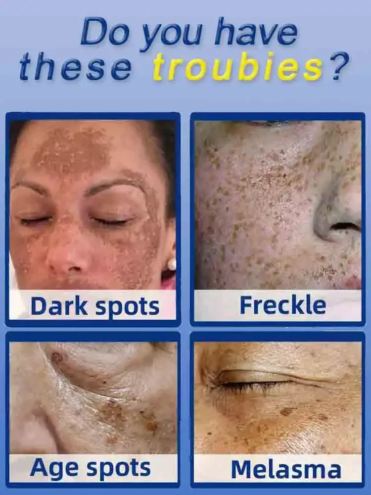 Effizienter Entferner für dunkle Flecken zur Gesichts entfernung Sommersprossen Melasma Chloasma senile Plaques Sonnenbrand Cyasma Chorio plaque Sommersprossen creme