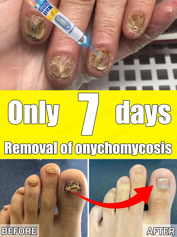 

Say goodbye to onychomycosis, no recurrence, no damage to nails.