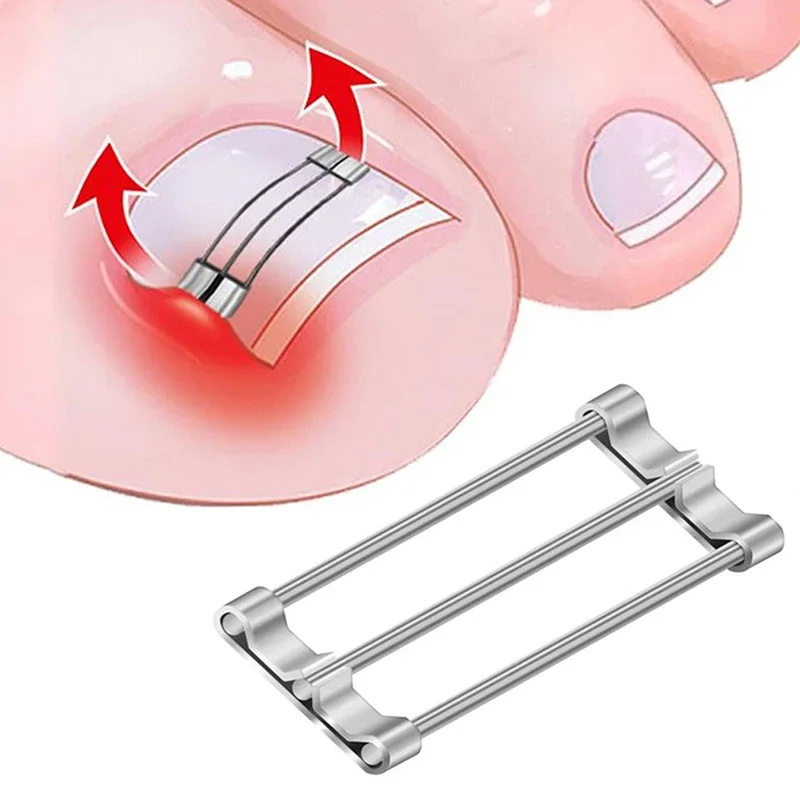 Corrector de uñas encarnadas, herramientas de sujeción, recuperación de pedicura, tratamiento de uñas encarnadas profesional, alisado de uñas encarnadas