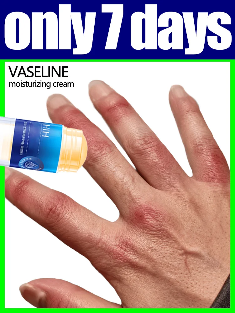 

ᴘʀᴇᴠᴇɴᴛ ᴄʜɪʟʙʟᴀɪɴꜱ. ꜱᴋɪɴ ᴄʀᴀᴄᴋɪɴɢ Vaseline hand and foot cream. Highly moisturizing.