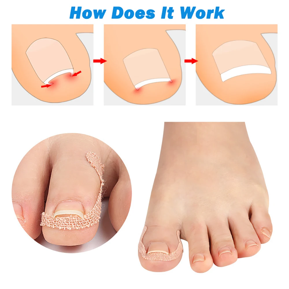 Pexmen 4/20/30/50Pcs Toenail Corrector Patch Nail Patches Ingrown Toenail Corrector Sticker Ingrown Toenail Treatment