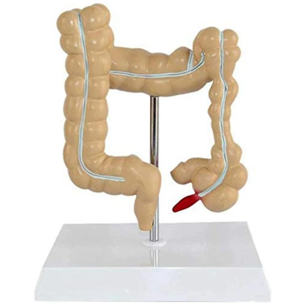 Colon Pathological Colorectal Cancer Model Large Intestine Model Gastrointestinal Anatomical Model