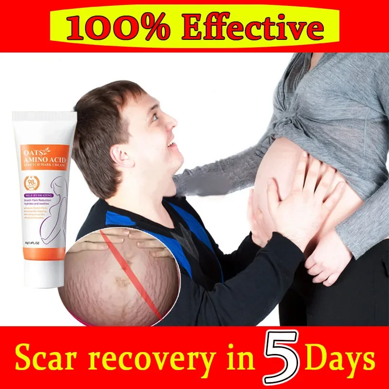 

Recovery Scar Cream Fast Removal Skin Scars Treat Surgery Scars Stretch Marks Acne Pox Prints Burn Repair Facial Care