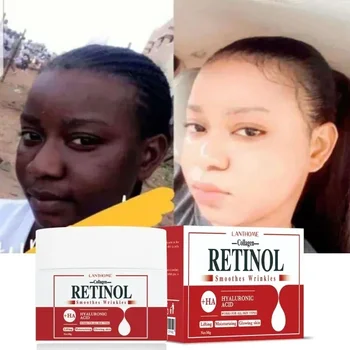 Gesicht Körper aufhellung creme Retinol Kollagen Hyaluron säure 3 in1 entfernen dunkle Flecken beseitigen Melanin zerstreuen Akne aufhellen die Haut