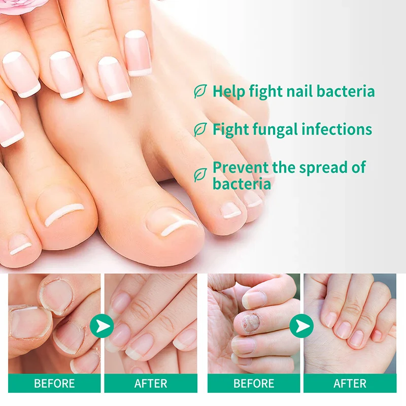 Fungal Nail Treatment Essence Oil Nail Fungus Laser Device Repair Toenail Fingernail Treatment Onychomycosis with Mushrooms 30ml