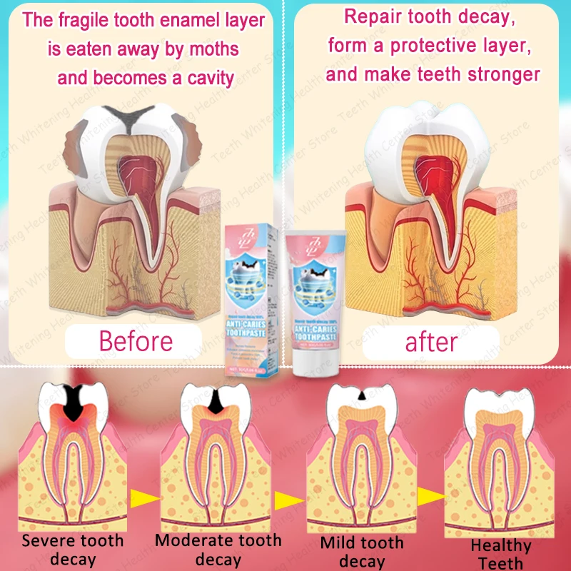 99% of people repurchase, hot selling, repair tooth decay.