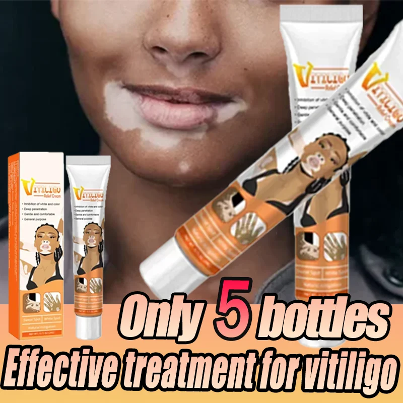 Vitiligo Remove Cream Ringworm White Spot Removal Skin care Vitiligo Eliminate Vitiligo White Spot