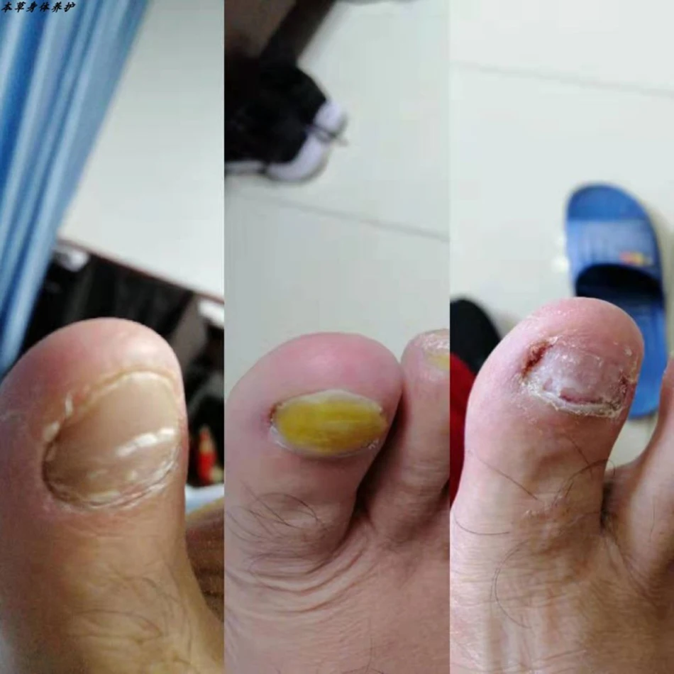 Essence Anti-betection pour Réparation des Ongles Gris N64.Beauty, Épaississement des Ongles