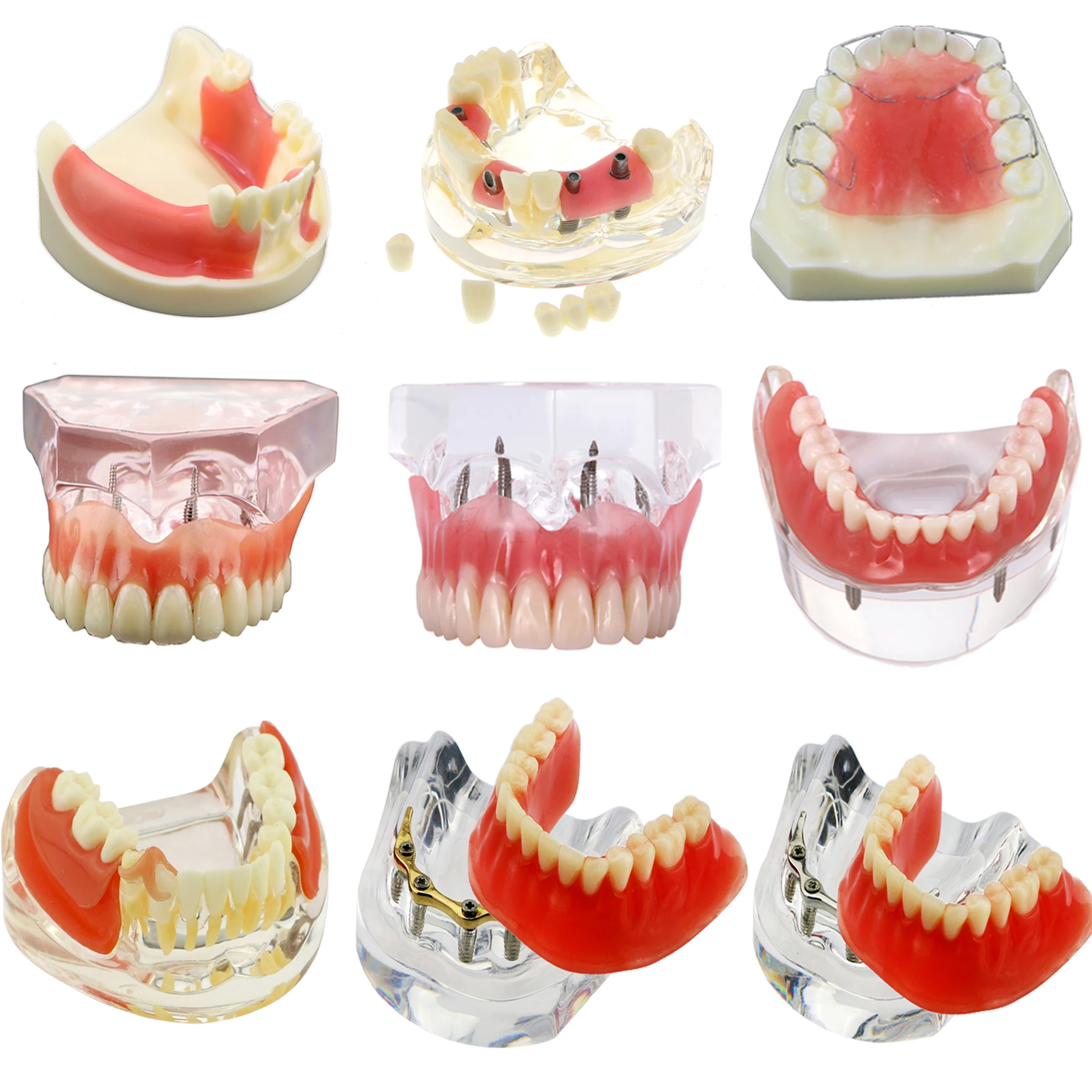 Teeth Implant Model Dental 2/4 Implant Overdenture Restoration Upper Lower Teeth Model Typodont  Implant Procedure