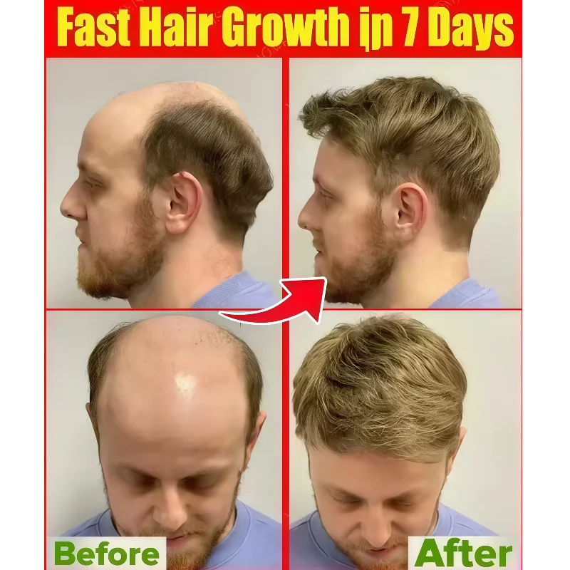 

80 LEDs Laser Hair Growth Cap, Red Light Therapy Hat 650nm for Hair Regrowth, Cold Laser Therapy for Men Women