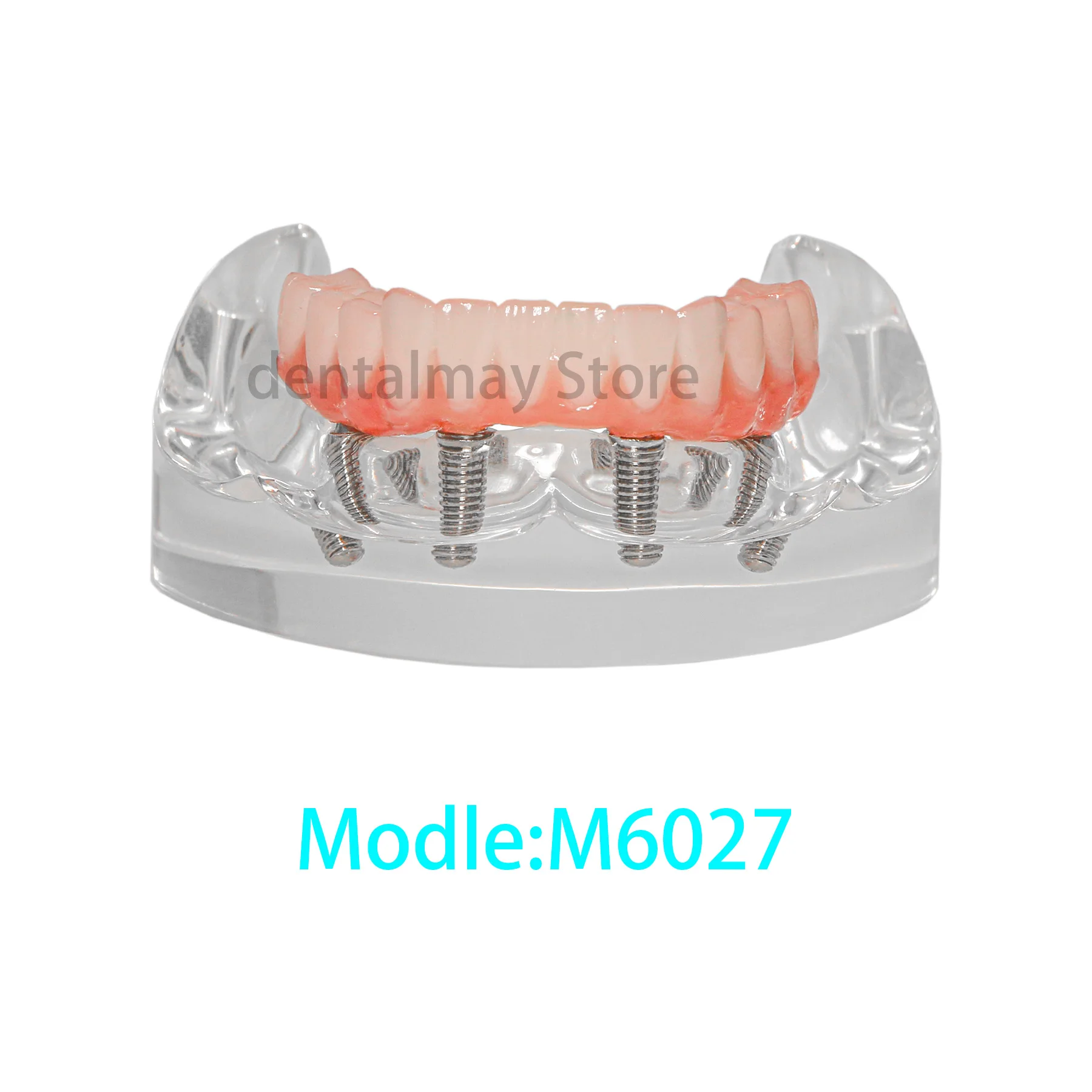 Upgrade New Style Dental Implant Restoration Model Lower Jaw with Post Core Bridge 4 Screws M6027