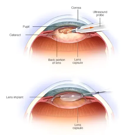 2025 Artificial Intraocular Lens for Cataract Surgery Hydrophobic Acrylic Aspheric Intraocular Lens Eye Surgery Lens