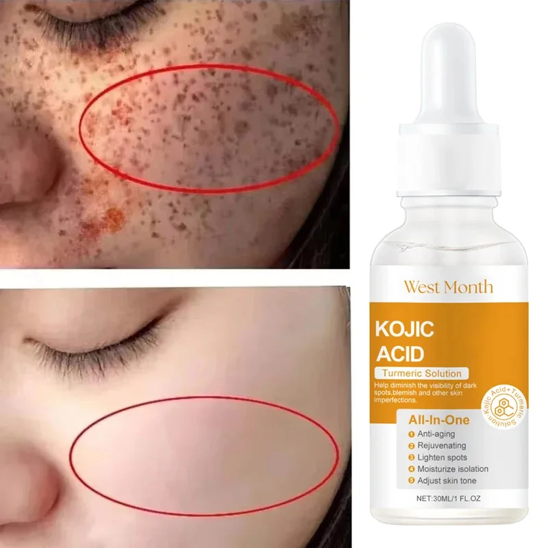 

Kojic Acid Freckle Removing Whitening Essence Fade Pigmentation Melasma Dark Spots Corrector Repair Serum Korean Face Skin Care