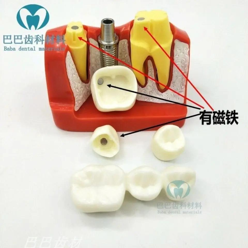 Oral and Dental Model 4 Times Implant Explanation Model, Crown Removable Implant Nail Display Model, Doctor-patient Communicatio