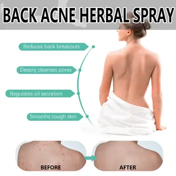 10 best sales Sırt sivilce spreyi - №2