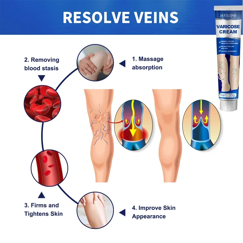 Laser Pen Lampshade Tool Varicose Veins Cream Remove Red Blood Streak Varicocele Vasculitis Phlebitis Strengthen Capillary