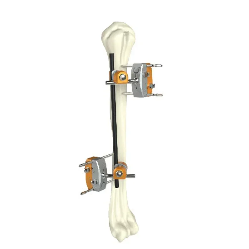 

Orthopedic Humeral Shaft External Fixator