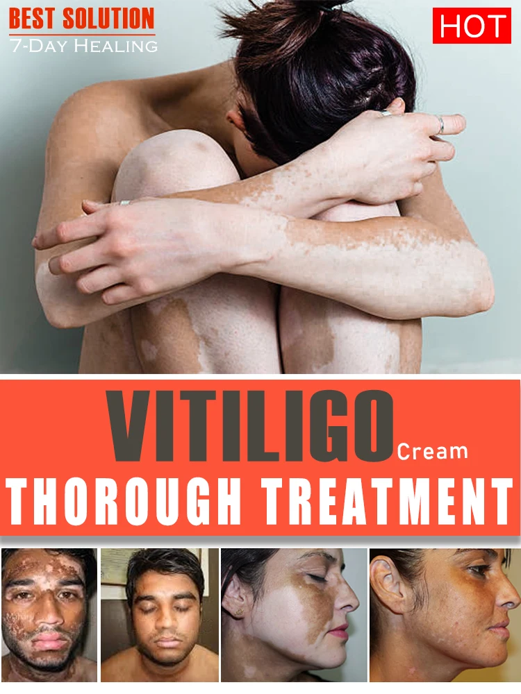 Vitiligo creme, 7 dias rápido, eliminar mancha branca e melhorar a pele