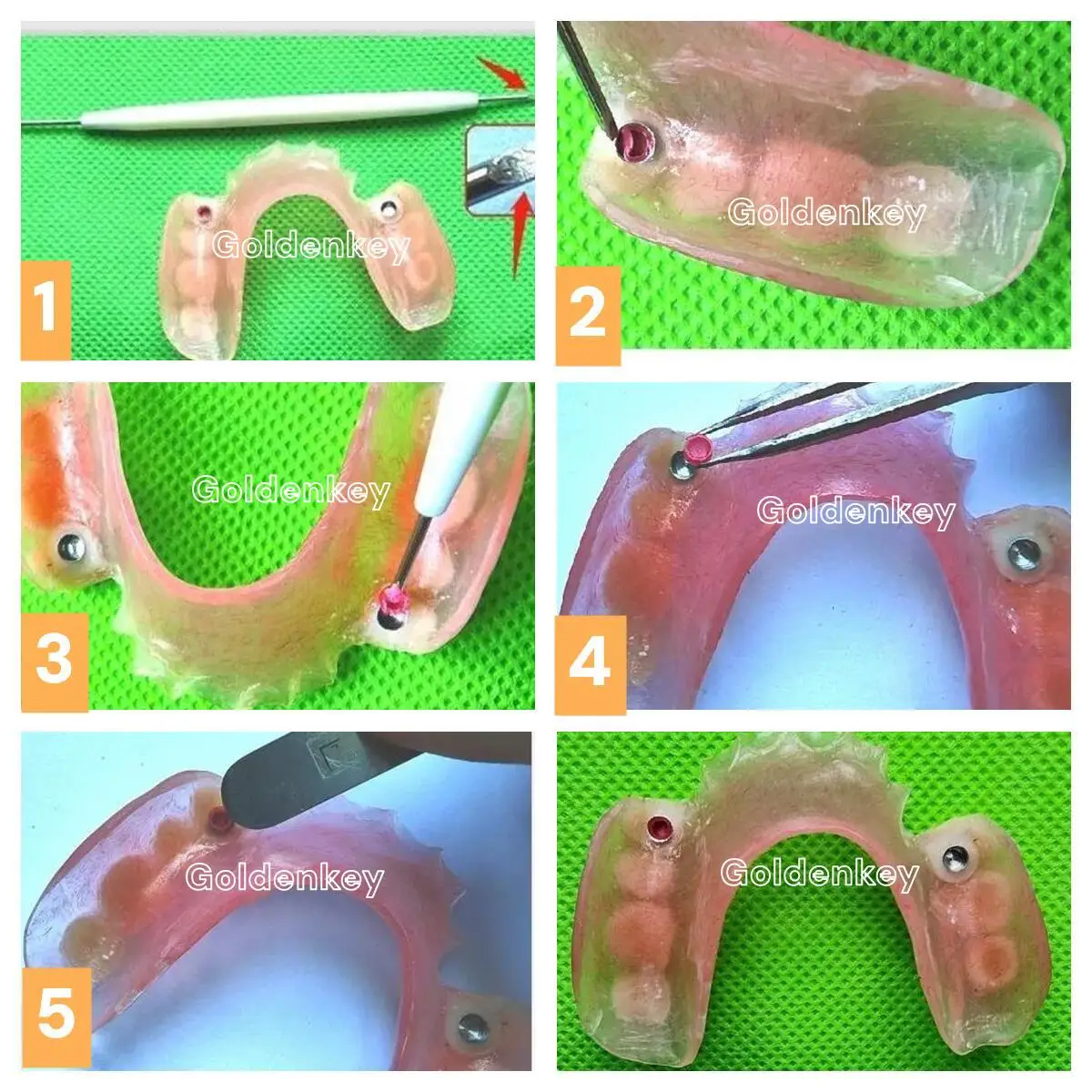 Dental Overdenture Locator Caps Attachment Denture Restorations Castable Ball Metal Housing Retention Style