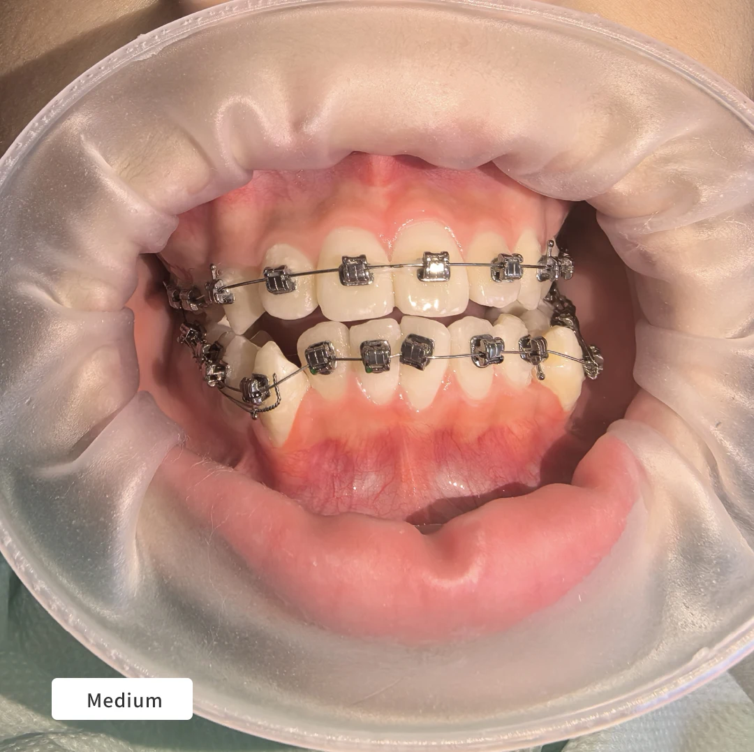 Dentpark 20 قطعة لكل صندوق ثلاثية الأبعاد على شكل حرف O خالية من اللاتكس ضام شفاه الأسنان متوسط/صغير لتقويم الأسنان وعزل استعادة