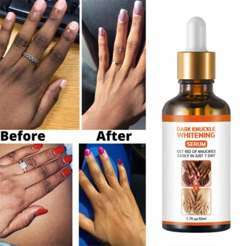 Dark Knuckles Fast Whitening Serum Hand Knuckle Removal Melanin Essence Elbows Knee Stains Remover Products Brightening Care