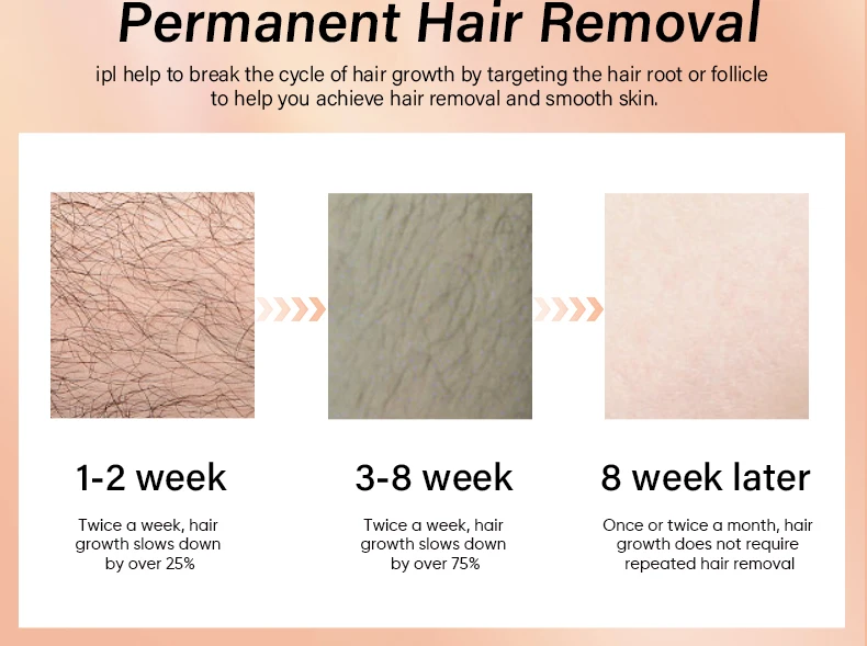 KODO 2026 High-end Customization Ice Laser Hair Removal Laser Epilator Permanent IPL Painless Photoepilator 4 in 1 Face and Body