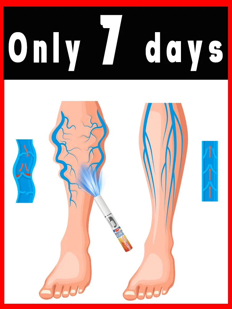 

Remove varicose veins in 7 days