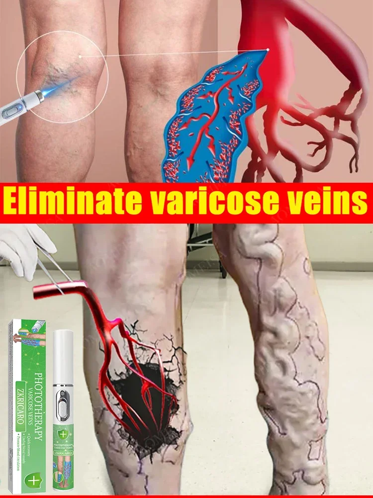 

Hot sale Nano Laser Leg Vein