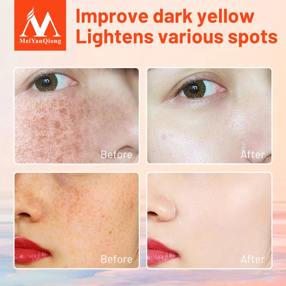 Face Freckle Cream Whitening Anti-aging Moisturizing Cream Melanin Removing Speckle Firm  Care Melasma Dark Spots Lighten Women
