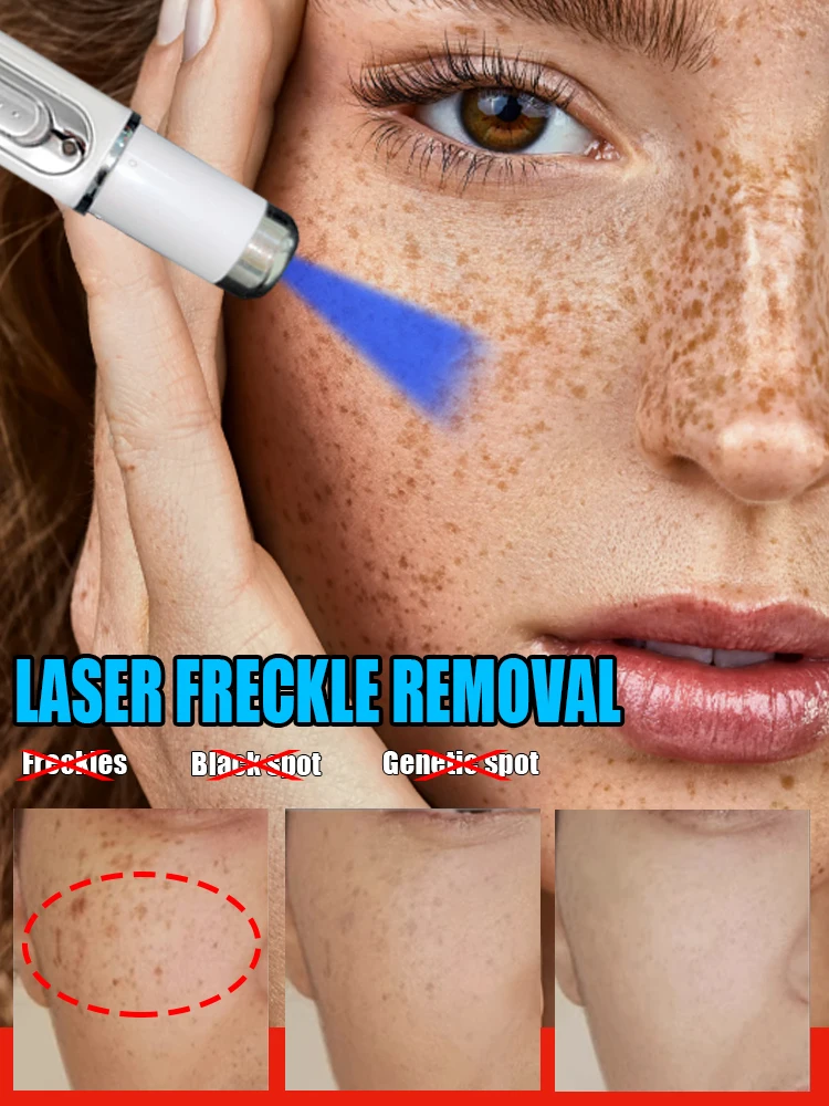 Fast laser repair of facial spots