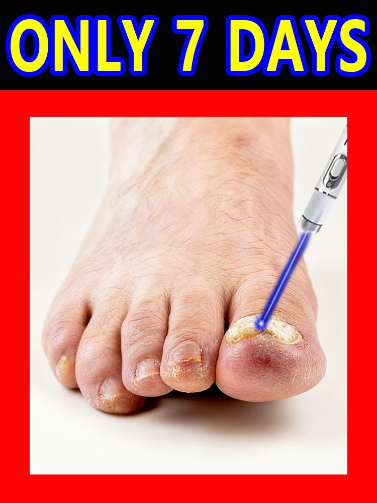 Laserowy aparat do leczenia grzybicy paznokci, bezbolesna i skuteczna alternatywa do leczenia grzybicy paznokci u stóp, domowe leczenie i regeneracja zdrowia paznokci u stóp.