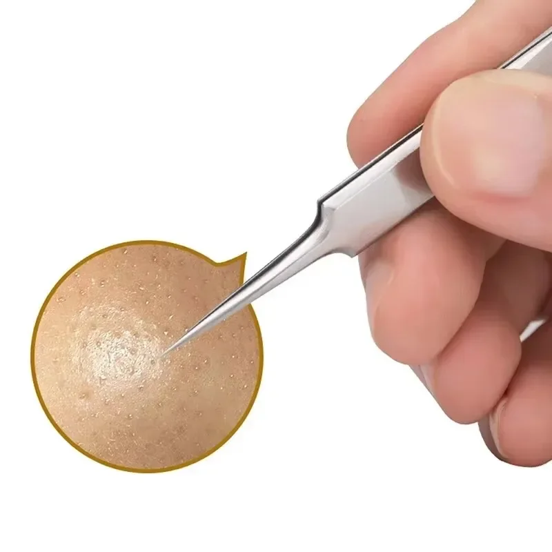 فائقة غرامة خلية البثور البثرة كليب الملقط صالون تجميل مزيل حب الشباب إبرة الرؤوس السوداء منظف عميق كليب الوجه العناية بالبشرة