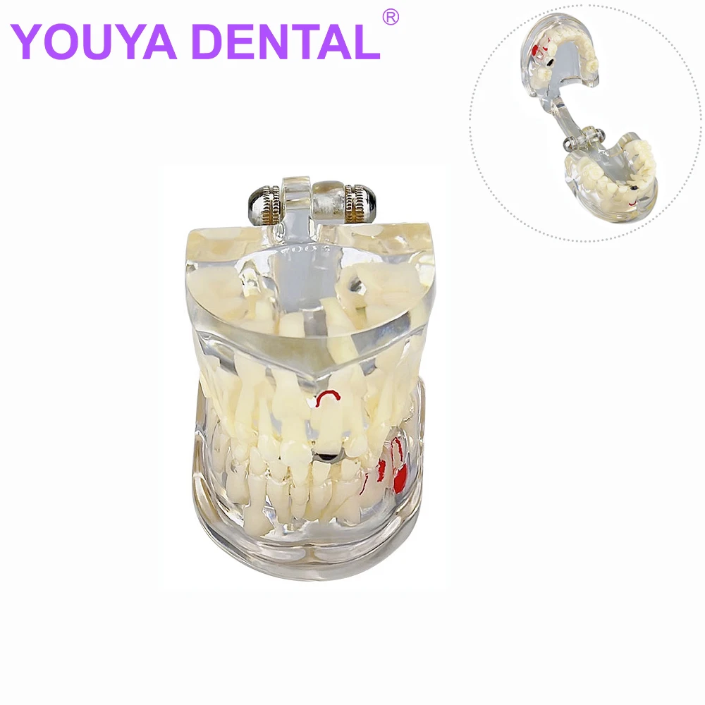 

Children Dental Teaching Model Children's Deciduous Tooth Pathology with Caries Deciduous for Dental Clinics Training Model Dent