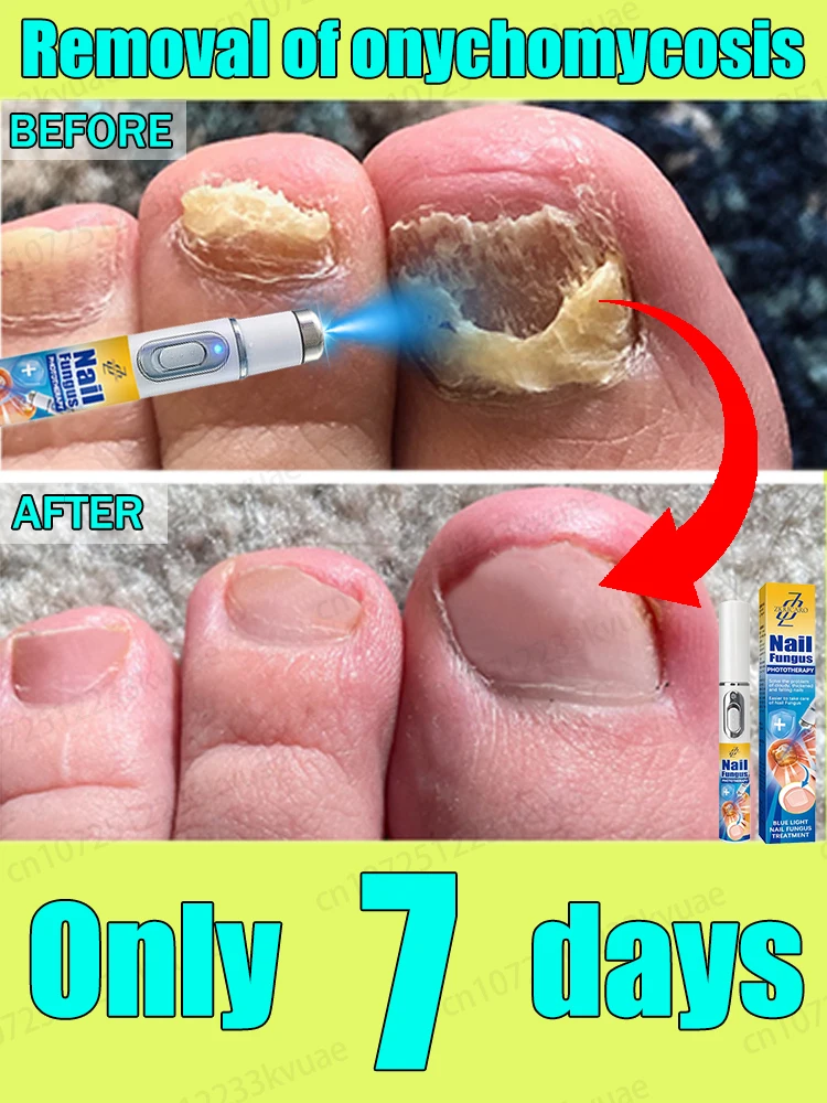 

Say goodbye to onychomycosis and avoid recurrence. Get normal nails again.