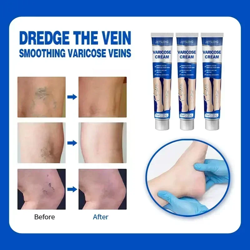 Effective Relief Varicose Vein Ointment Relieve Varicose Vein Vasculitis Spider Legs Pain Treatment Care Essential Cream