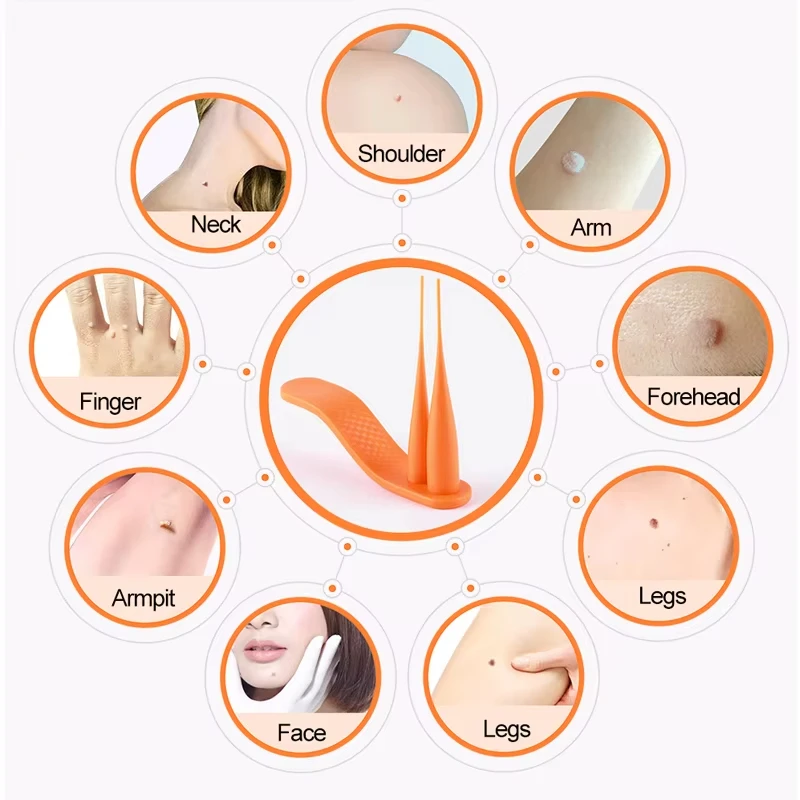 Zestaw narzędzi 2-w-1 do bezbolesnego usuwania brodawek, znamion, plam, zaskórników i kurzajek z pisakiem do usuwania oraz wacikami do czyszczenia, narzędzie do pielęgnacji skóry twarzy