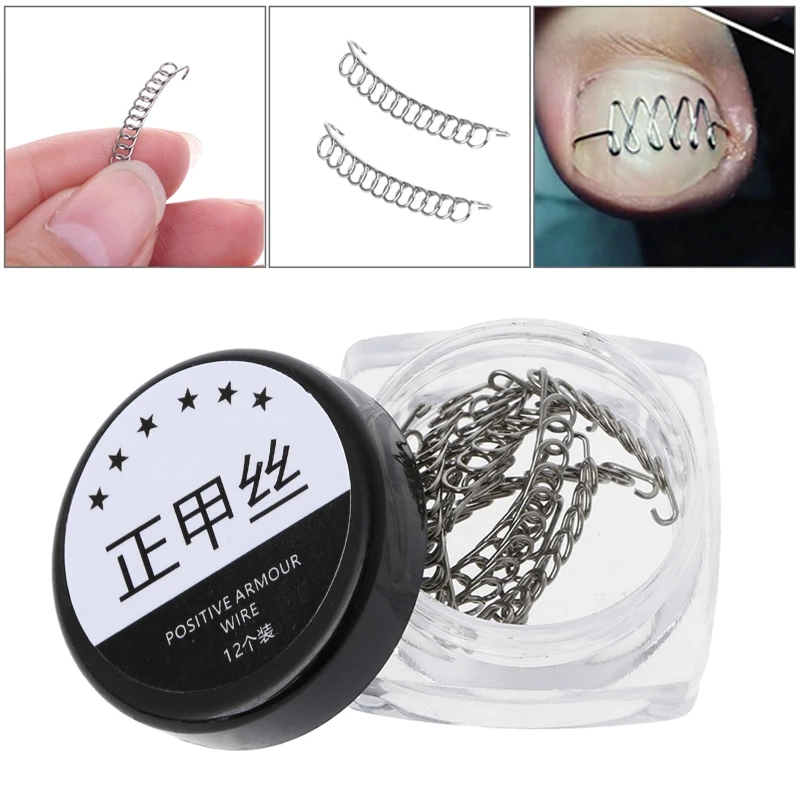 การแก้ไขเล็บเท้าคุด Pedicure Wire Fixer Paronychia Recover เครื่องมือ Home